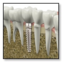 illustration of a dental implant cross-section