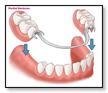 illustration of a partial denture