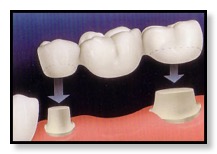 illustration of a dental bridge