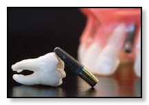 example dental implant and tooth laying on table