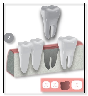 removal of the problematic tooth diagram