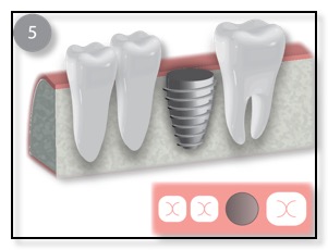 placement of the dental implant diagram