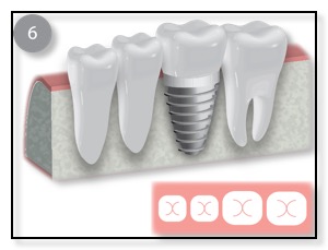 restored dental implant diagram