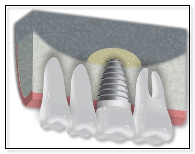 dental implant sinus lift diagram