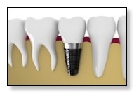 small implant pic